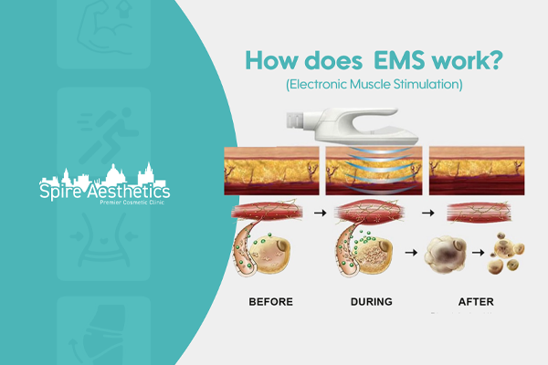 EMS treatment for post pregnancy weight loss treatment Teddington