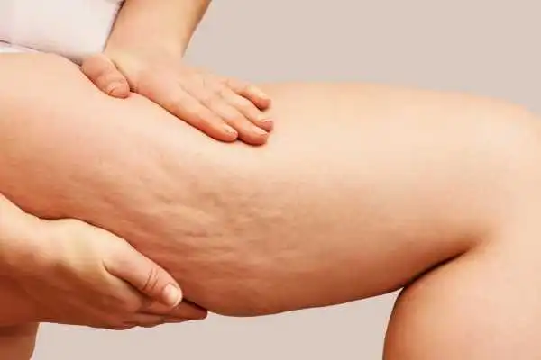 Image of woman showing leg with cellulite Teddington