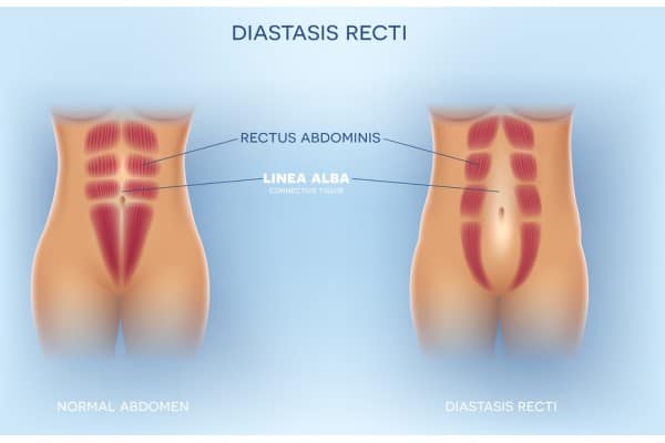 What Non-Surgical Options Are Available for Diastasis Recti Teddington?