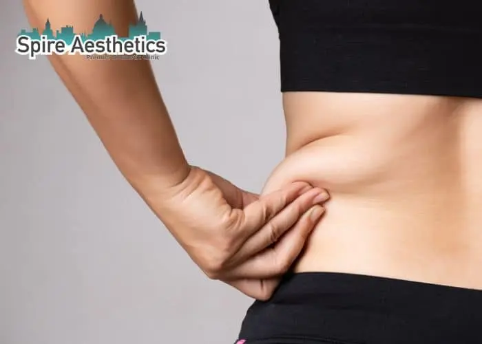 Image of woman pinching fat on their hips Teddington. Fat Freezing treatment