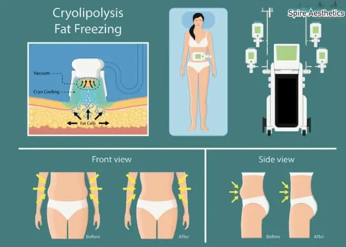 Fat freezing treatment Teddington benefits for competitions to remove stubborn fat deposits.
