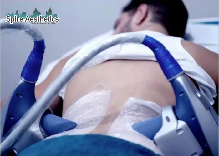 Man having fat freezing treatment done on love handles before a competitions Teddington to create a sculpted look.