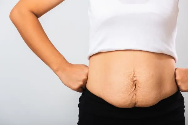 Image of a woman's stomach after weight loss with sagging skin following a gastric band Teddington