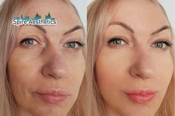 Morpheus8 Treatment Teddington Before & After Results