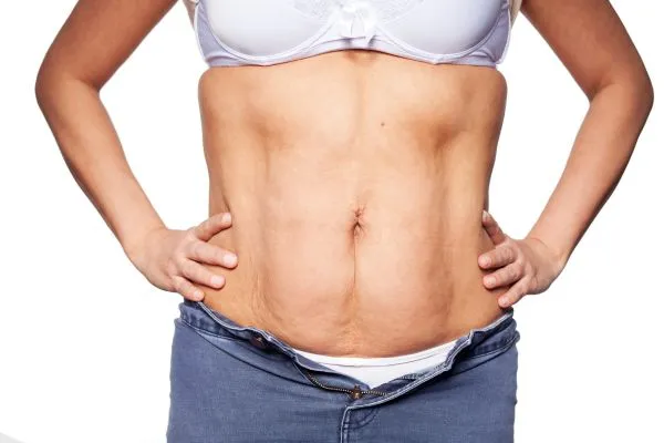 sagging skin on woman's stomach after weight loss injections Teddington