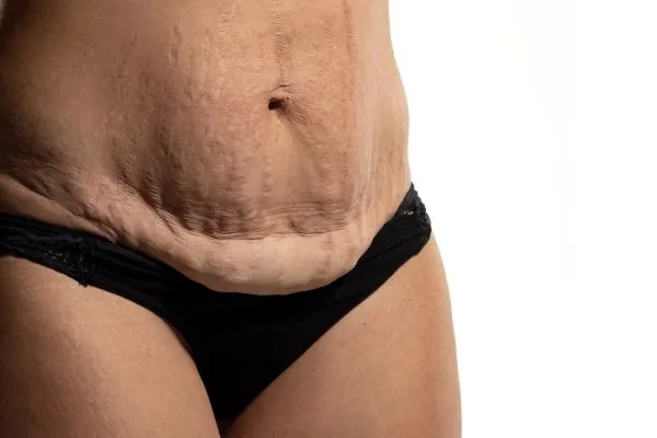 Image of womans stomach after weight loss injections Teddington showing saggy skin
