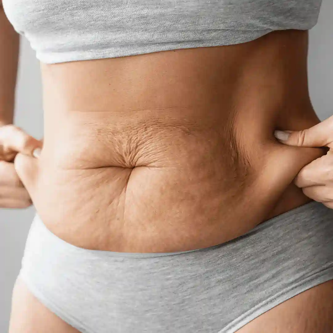 Is It Normal to Have Loose Skin After Pregnancy Teddington?