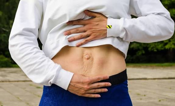 When Could Diastasis Recti Be the Missing Piece of the Puzzle Teddington?
