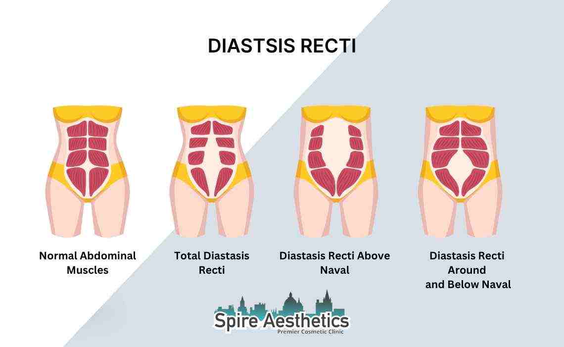 Is Non-Surgical Diastasis Recti Treatment Right for You? Common Concerns Answered Teddington